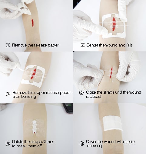 Instructions pour le dispositif de fermeture de plaie