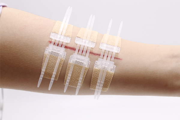 Kit di lacerazione del cerotto per dispositivo di chiusura della ferita non invasivo Longmed