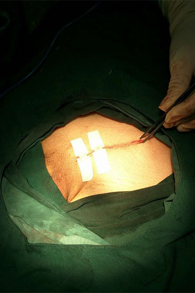 جهاز إغلاق الجرح ZipStitch خياطة الجروح