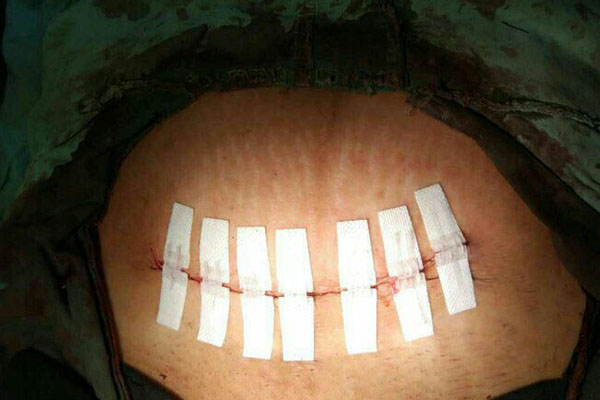 Fechamento de Feridas Pontos Fechamento de Pele Cicatrizes Redutor de Hiperplasia