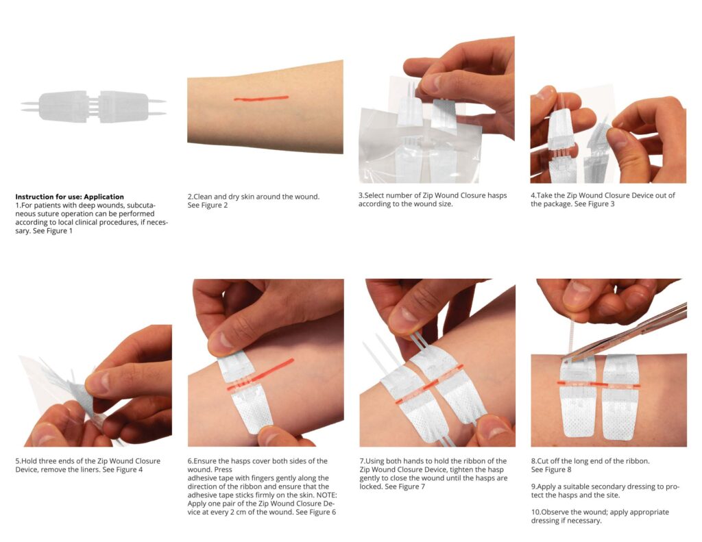 Zip Stitch Wound Closure Device Band Aid