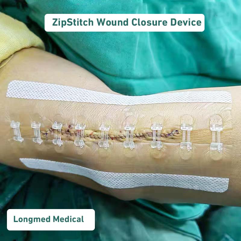 Longmed Medical ZipStitch 創傷閉鎖デバイス包帯