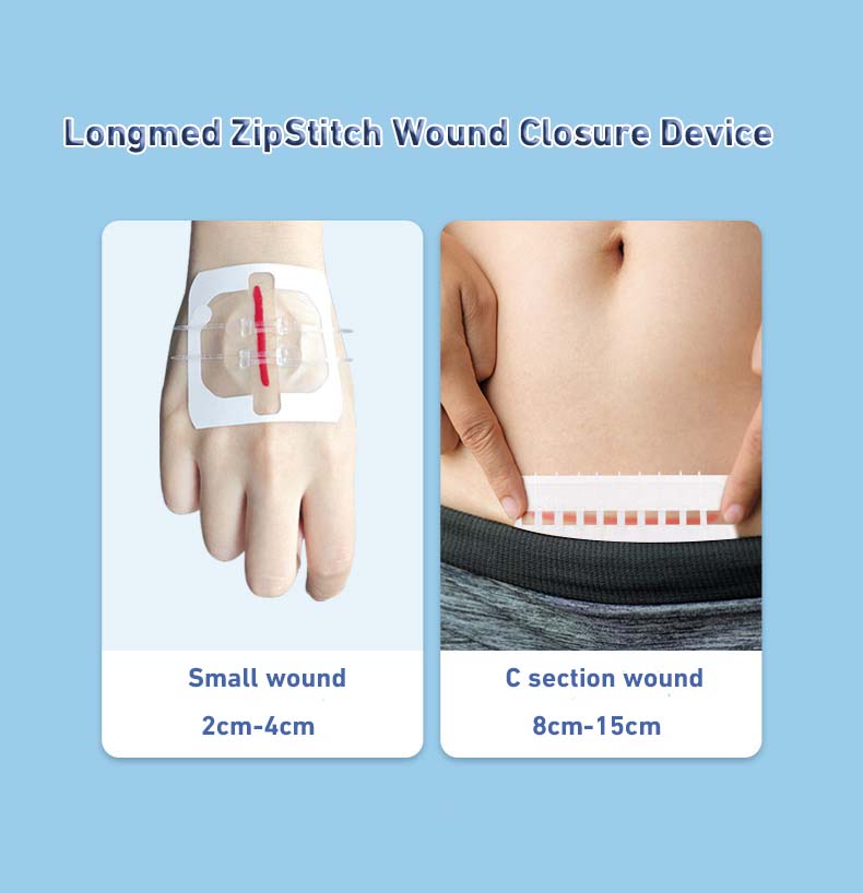 Zariadenie na uzatváranie rany na zips Longmed pre ranu v sekcii C