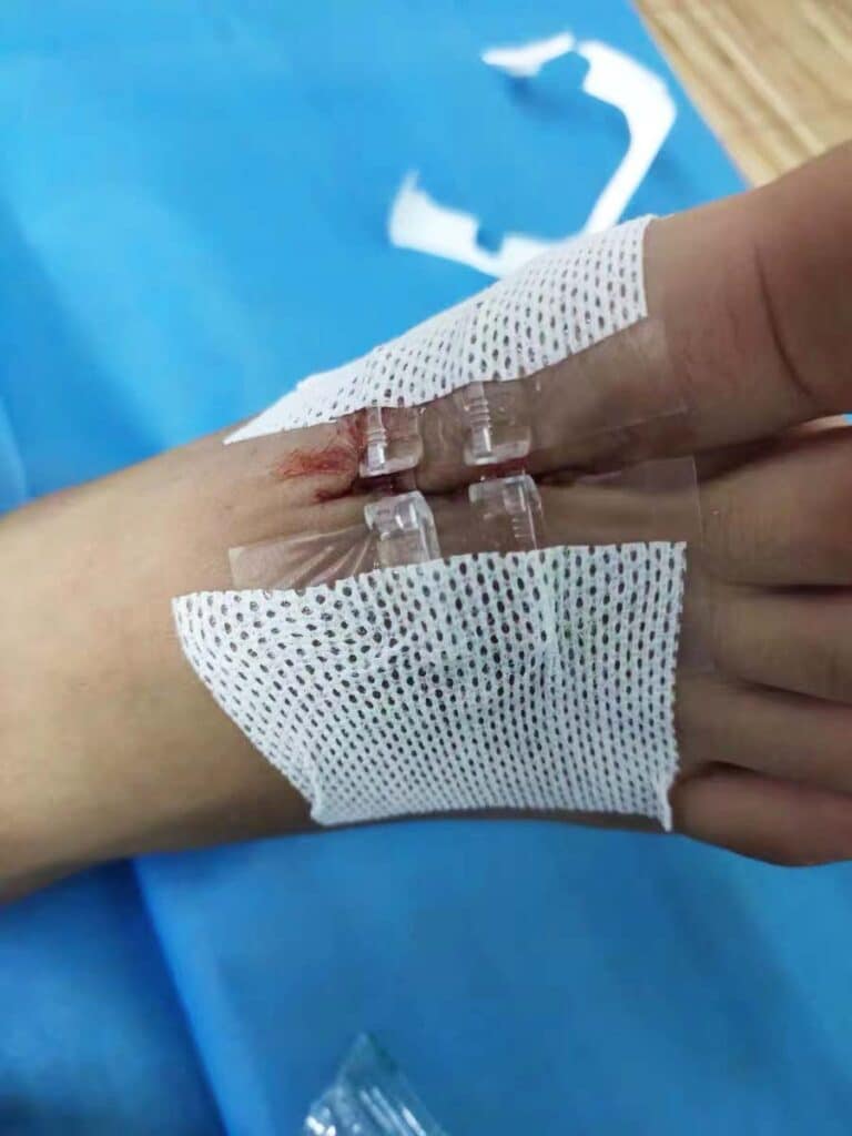 Zip Stitch Longmed BandAid Ράμματα Steri Strip για κλείσιμο πληγών