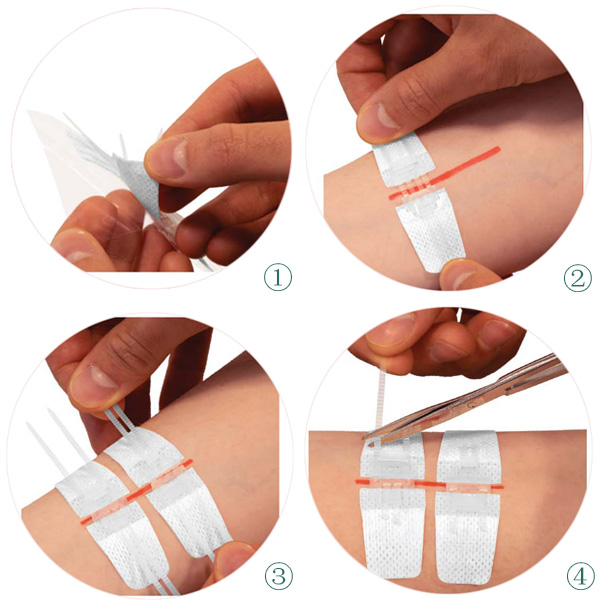 Dispositivo de fechamento de ferida de sutura com zíper Tiras de fechamento de pele