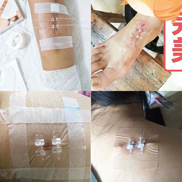 Zip Stitch Sutures Zhejiang Longmed Wound Closure Device แถบผิวหนัง