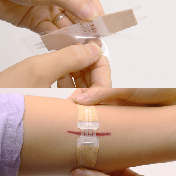 Dispositivo di sutura a ferita lunga con punto zip