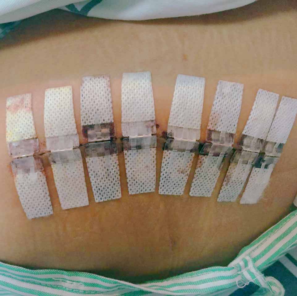Dispositivo di chiusura della ferita di grado ospedaliero longmed con punto zip
