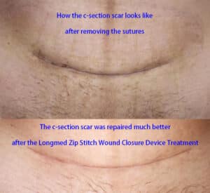 Caesarean Cesarean Section C Section Scar Treatment