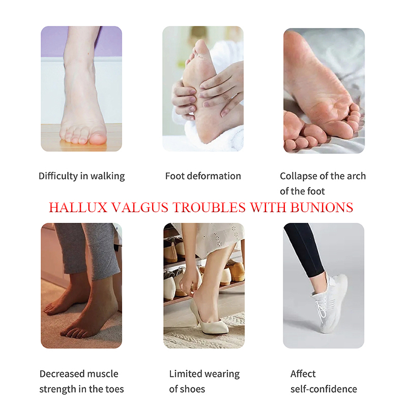 ΠΡΟΒΛΗΜΑΤΑ HALLUX VALGUS ΜΕ ΤΑ ΔΑΚΤΥΛΑ ΤΩΝ ΔΑΧΤΥΛΙΩΝ